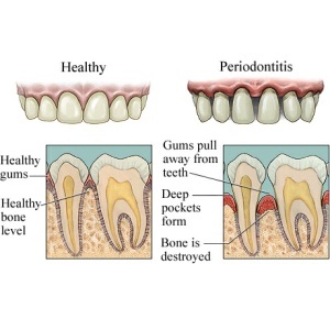 Symptoms of Gum Disease